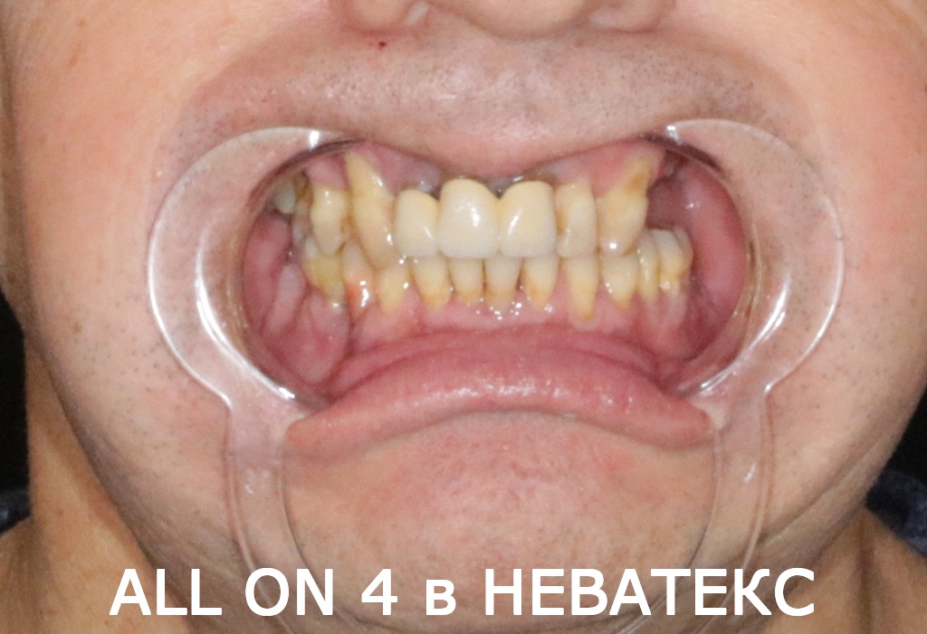 all on 4 фото до имплантации клиника неватекс all on 4 фото до имплантации